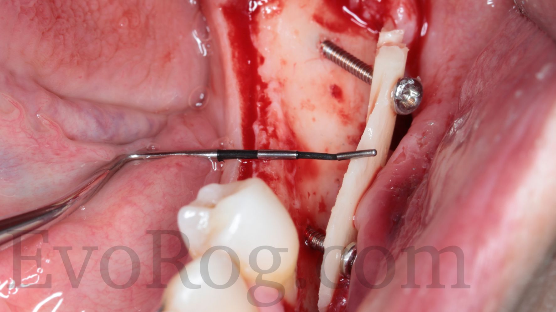 Fijación de injertos con EvoScrew